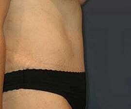 Tummy Tuck Before & After