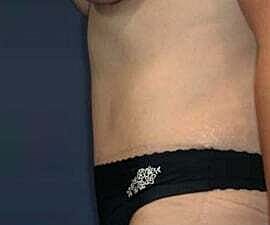 Tummy Tuck Before & After