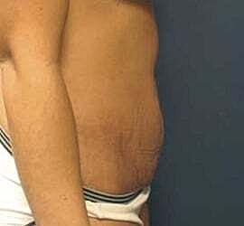 Tummy Tuck Before & After
