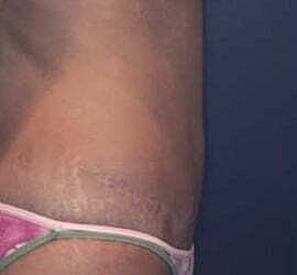 Tummy Tuck Before & After