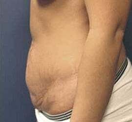Tummy Tuck Before & After