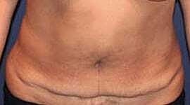 Tummy Tuck Before & After
