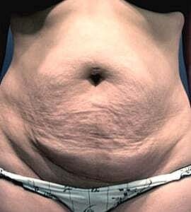 Tummy Tuck Before & After