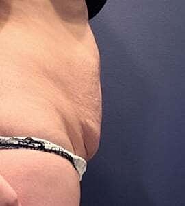 Tummy Tuck Before & After