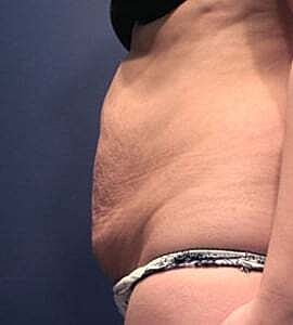 Tummy Tuck Before & After