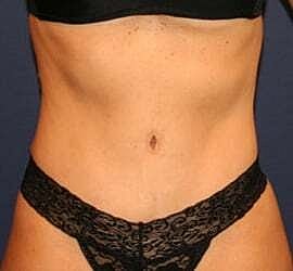 Tummy Tuck Before & After