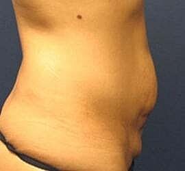 Tummy Tuck Before & After
