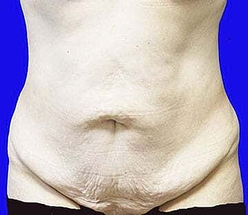 Tummy Tuck Before & After