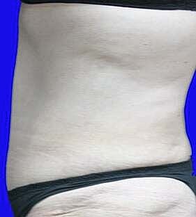 Tummy Tuck Before & After