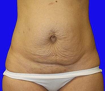 Tummy Tuck Before & After