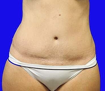 Tummy Tuck Before & After