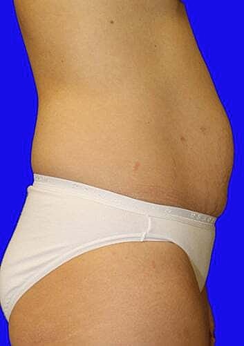 Tummy Tuck Before & After