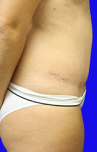 Tummy Tuck Before & After
