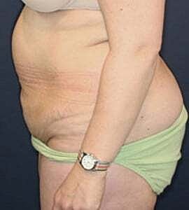 Tummy Tuck Before & After