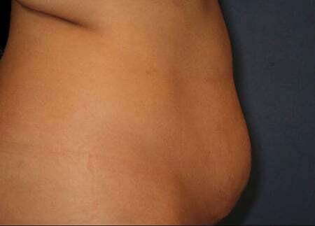 Tummy Tuck Before & After