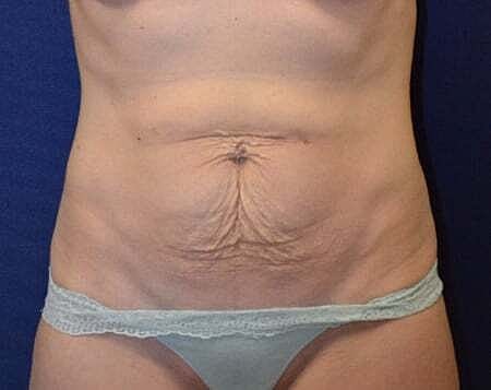 Tummy Tuck Before & After
