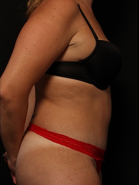 Tummy Tuck Before & After
