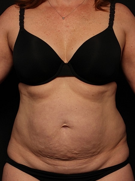 Tummy Tuck Before & After