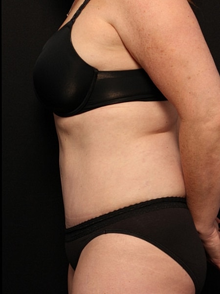 Tummy Tuck Before & After