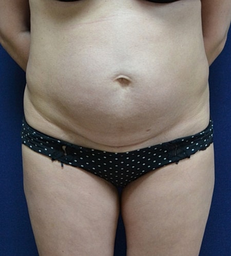 Tummy Tuck Before & After