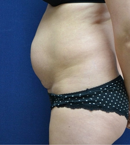 Tummy Tuck Before & After