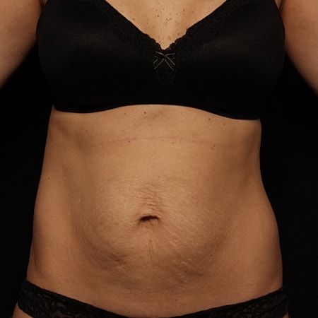 Tummy Tuck Before & After