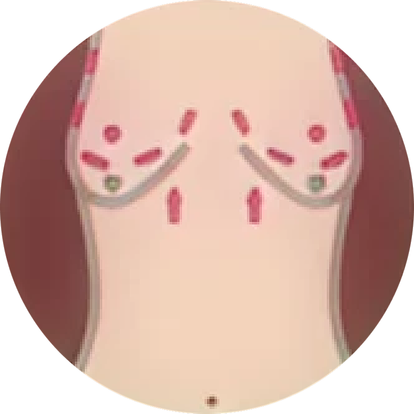 Illustration of a torso with markings.
