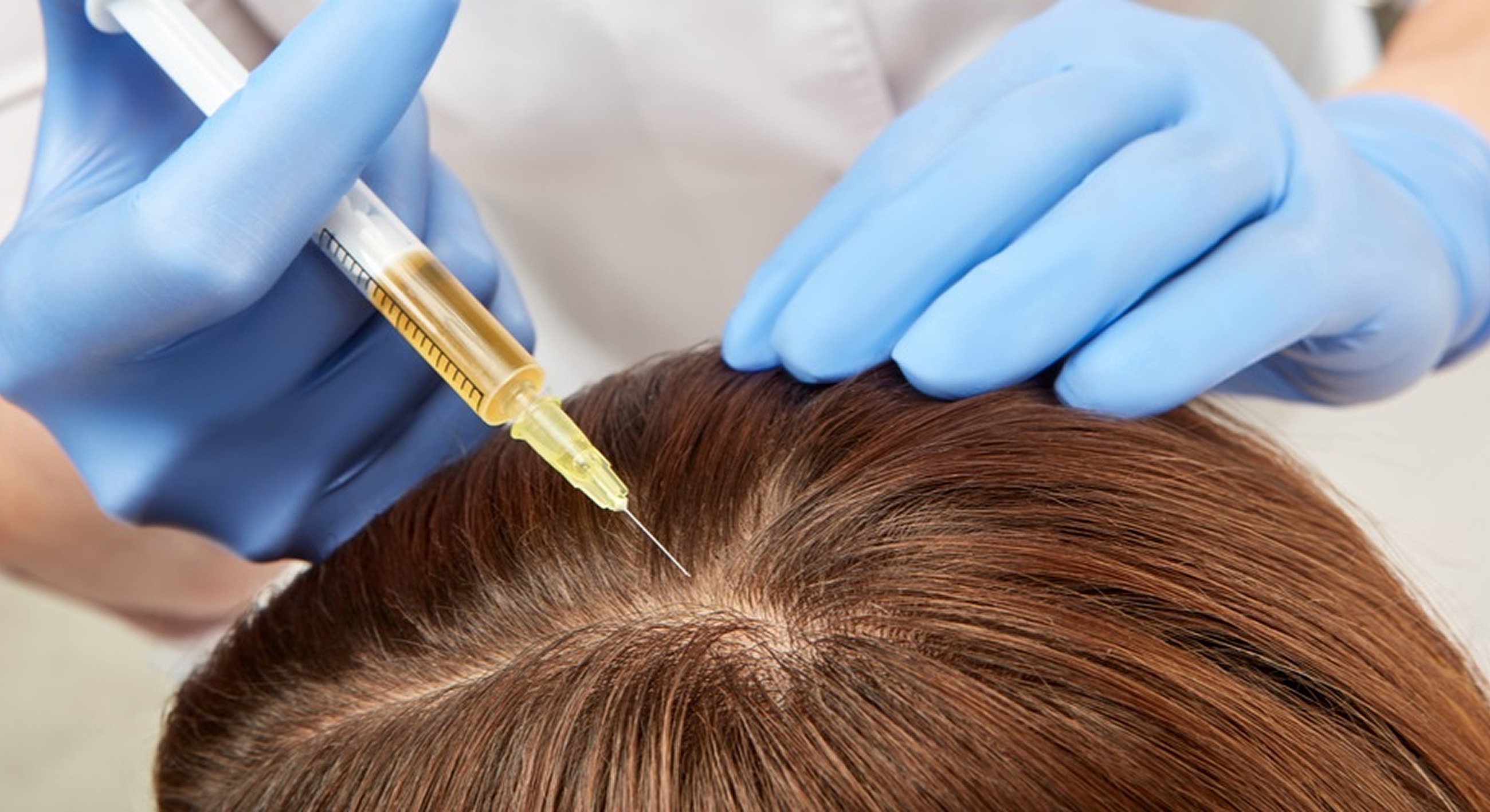 Scalp injection treatment for hair restoration.